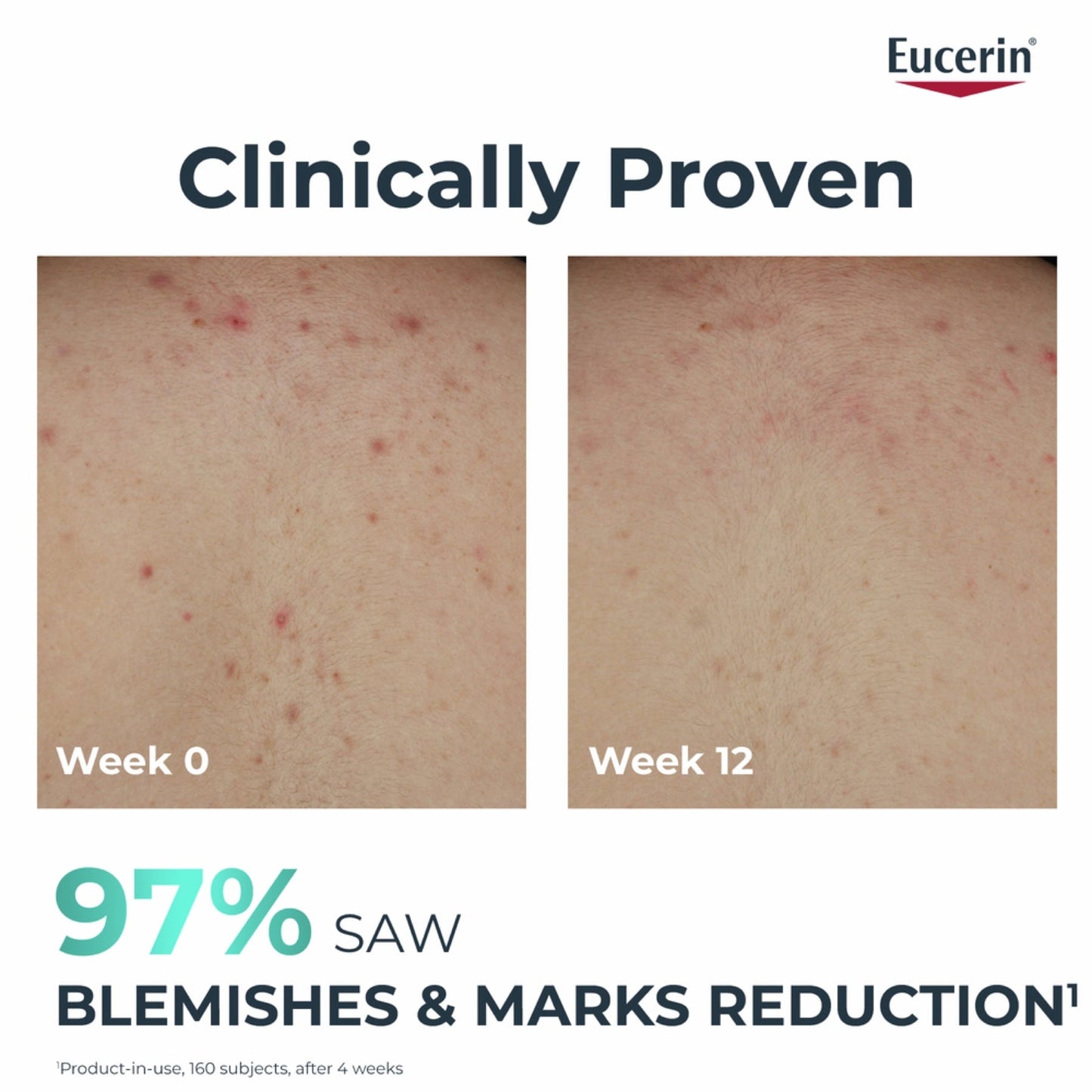 Eucerin Dermopure Clinical Correcting Body Cream for Blemishes & Acne-prone Skin, 200ml