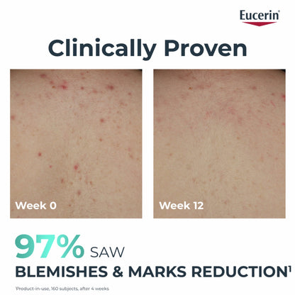 Eucerin Dermopure Clinical Correcting Body Cream for Blemishes & Acne-prone Skin, 200ml