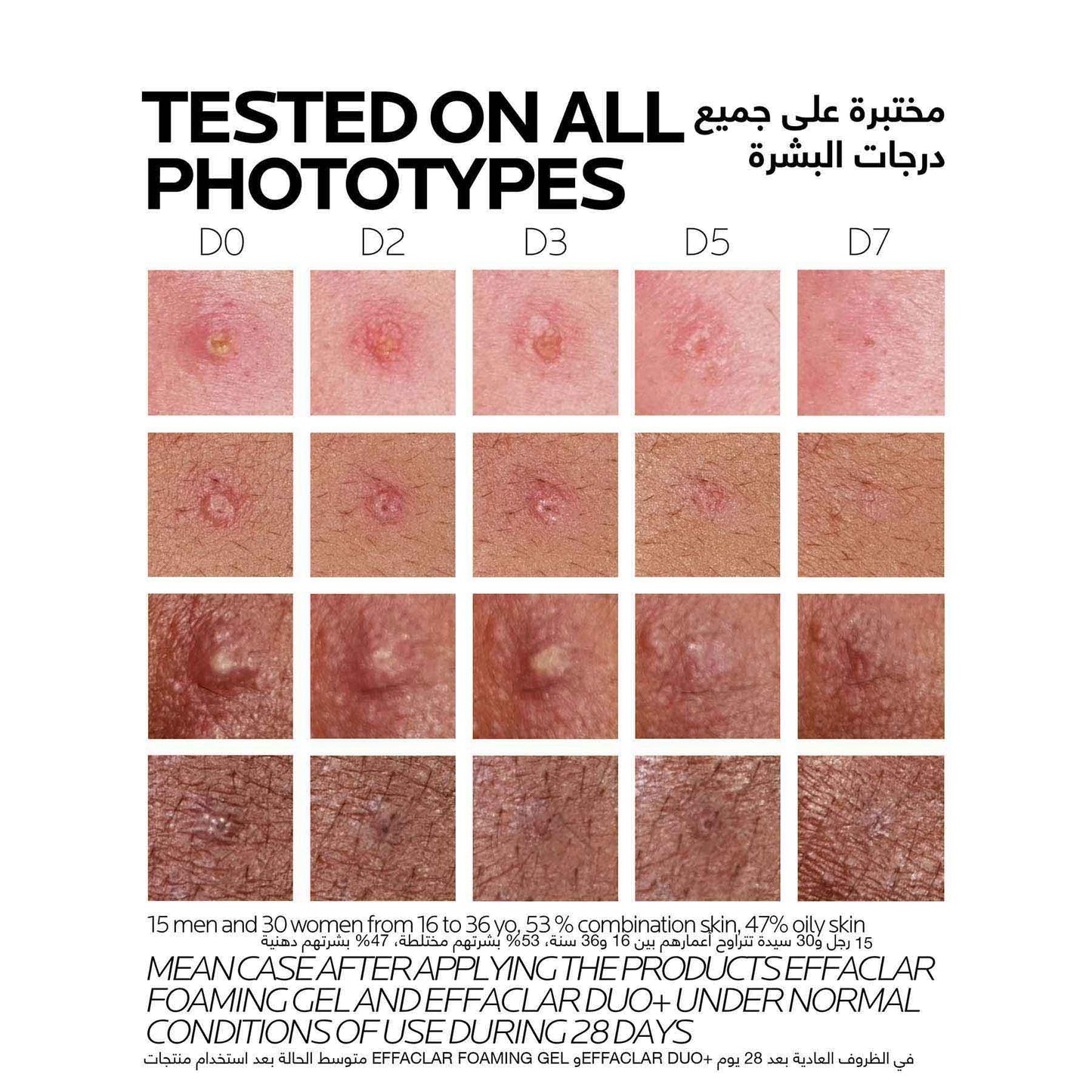 La Roche-Posay Effaclar Duo (+M) Acne Treatment Cream for Oily and Acne-Prone Skin 40ml