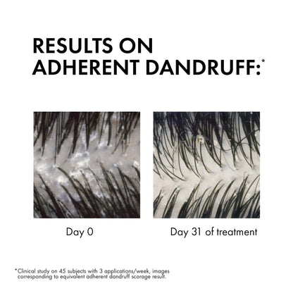 Vichy Dercos Anti-Dandruff Shampoo for Normal to Oily Hair 390ml