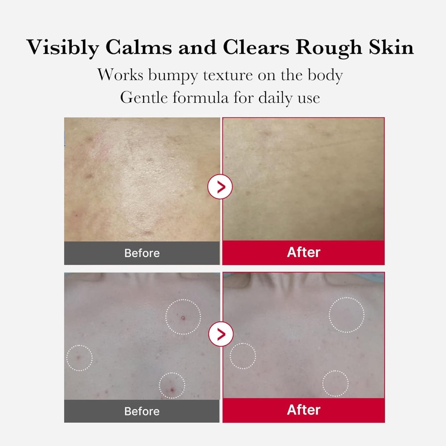 Medicube Red Acne Body Peeling Shot 2.0 110g