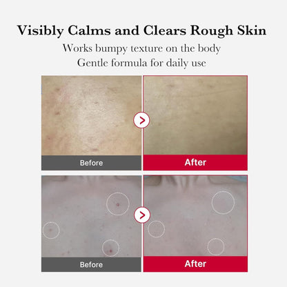 Medicube Red Acne Body Peeling Shot 2.0 110g