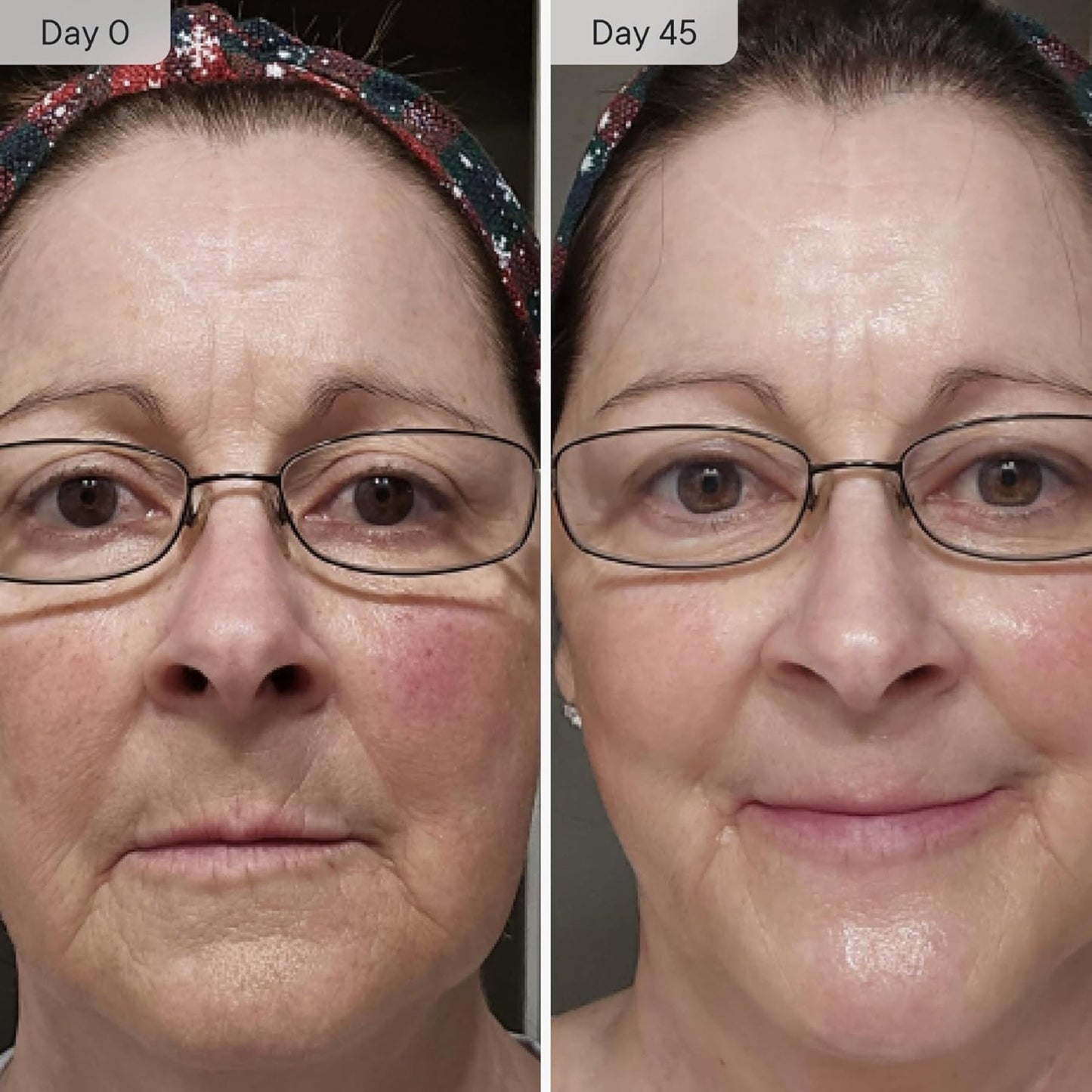 Qure Micro Infusion System for Face Wrinkles