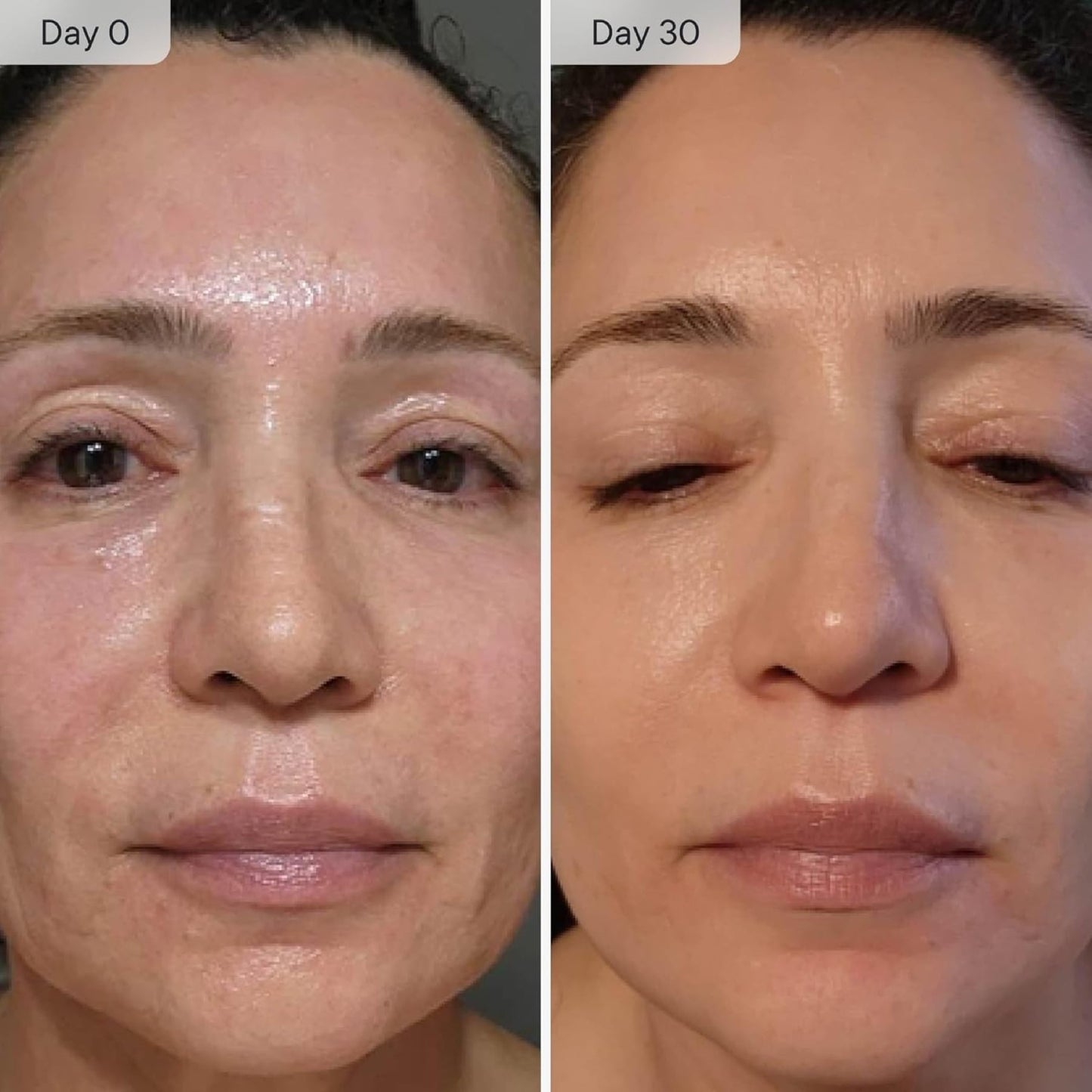 Qure Micro Infusion System for Face Wrinkles