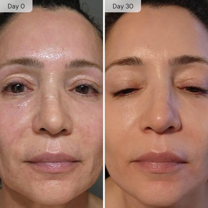 Qure Micro Infusion System for Face Wrinkles