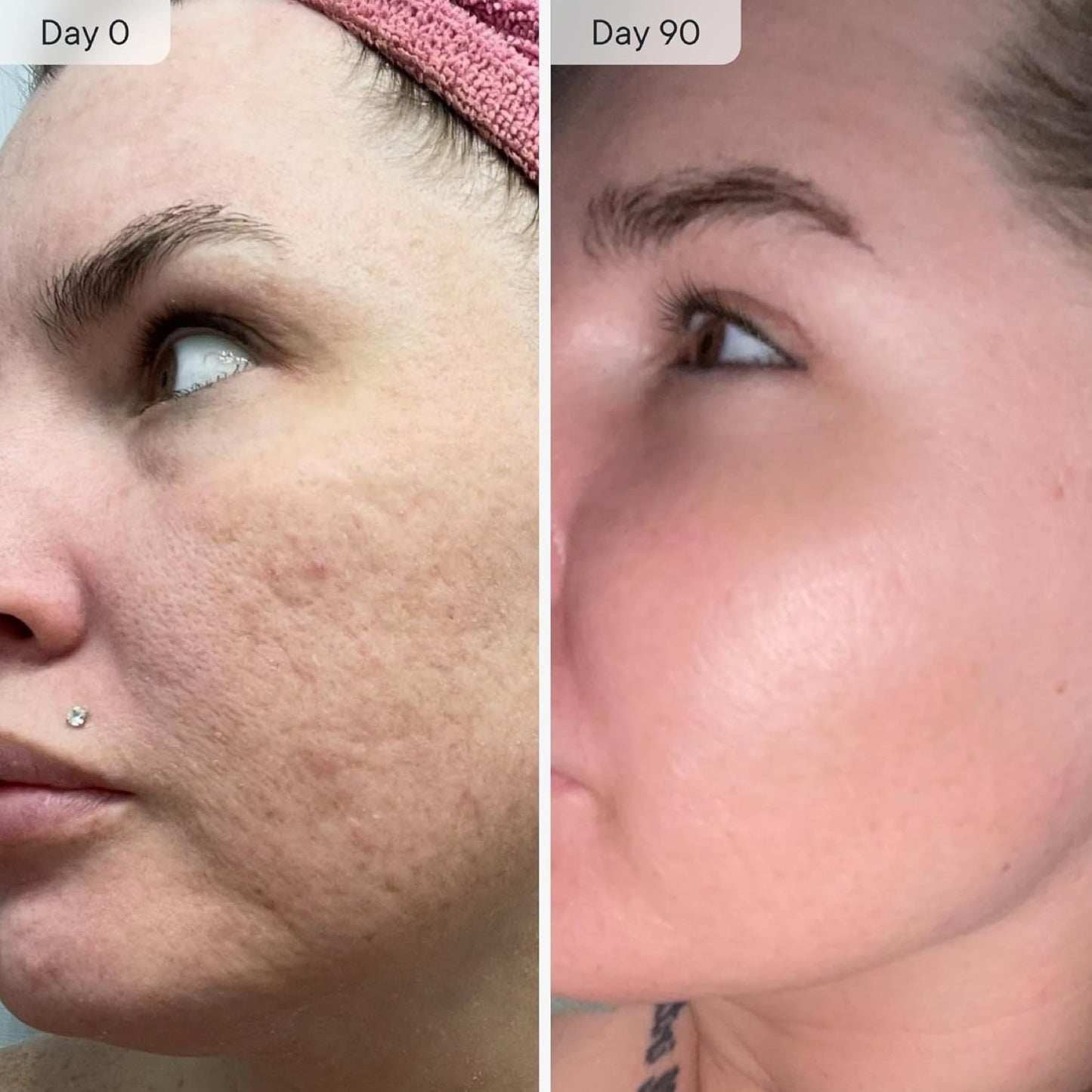 Qure Micro Infusion System for Dark Spots
