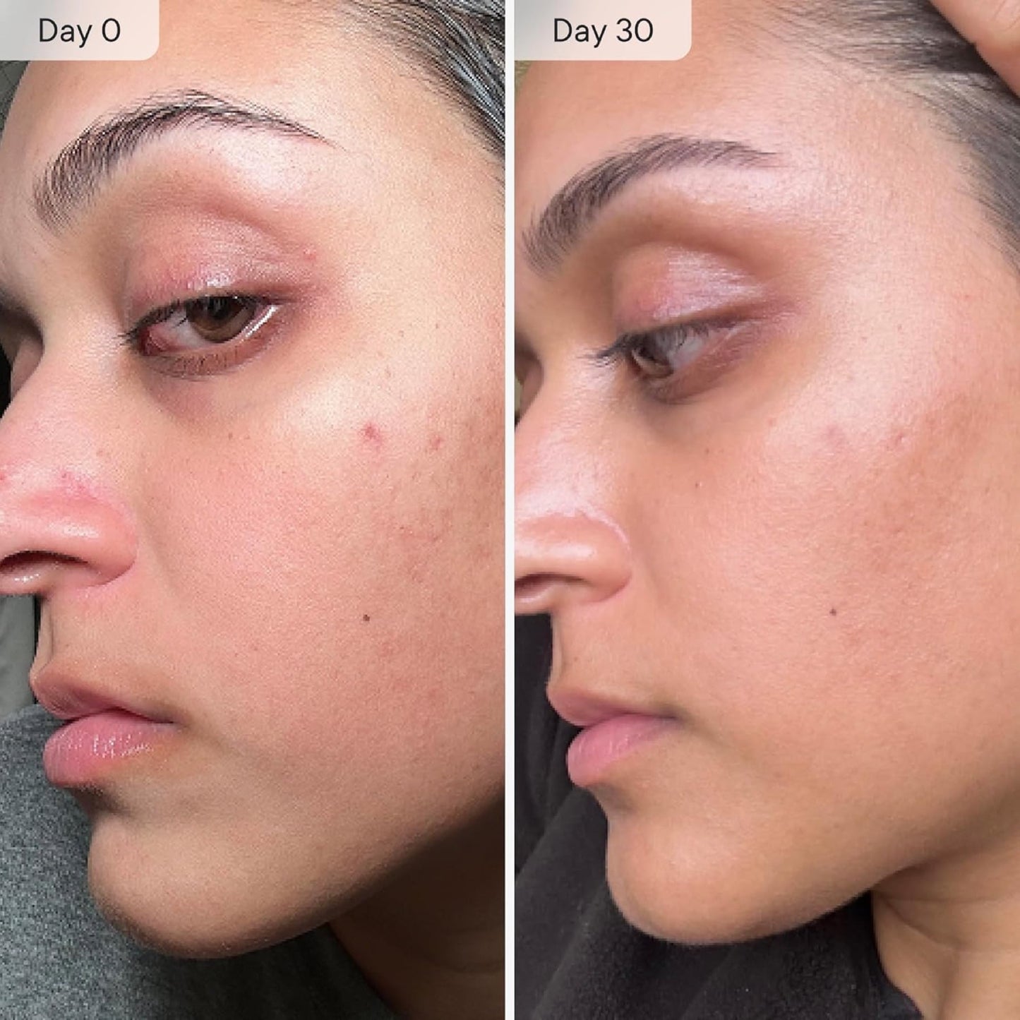 Qure Micro Infusion System for Dark Spots
