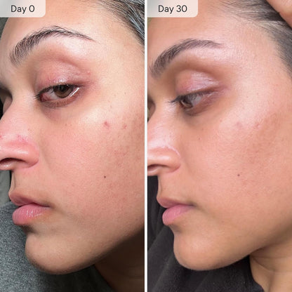 Qure Micro Infusion System for Dark Spots